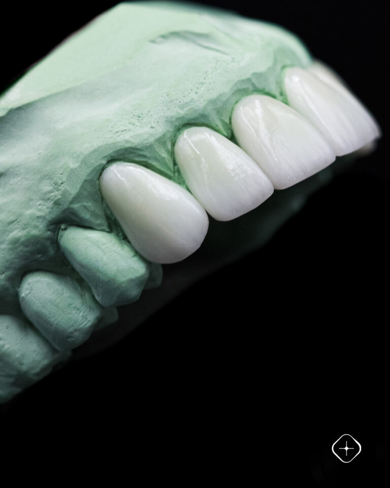 Técnica, detalle y confianza.🦷 Carillas de porcelana.#LaboratorioDental #DedicadosALaPrecisión (1)