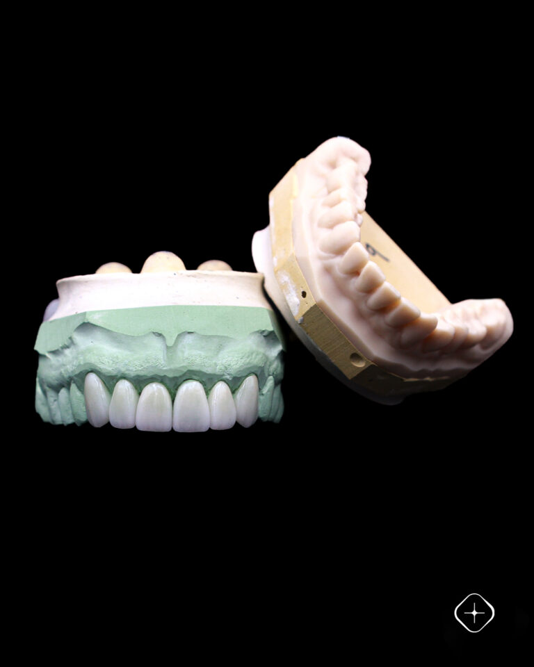 Técnica, detalle y confianza.🦷 Carillas de porcelana.#LaboratorioDental #DedicadosALaPrecisión (2)