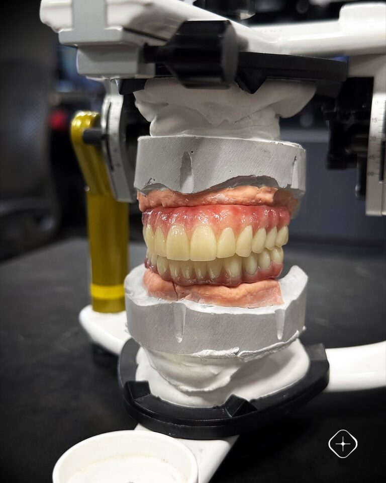 🦷 Prótesis híbrida sobre barra de titanio, fabricadas en Prime Multistratum® y estratificadas c (1)