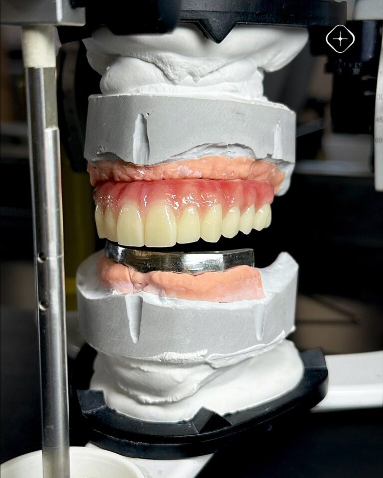 🦷 Prótesis híbrida sobre barra de titanio, fabricadas en Prime Multistratum® y estratificadas c (2)