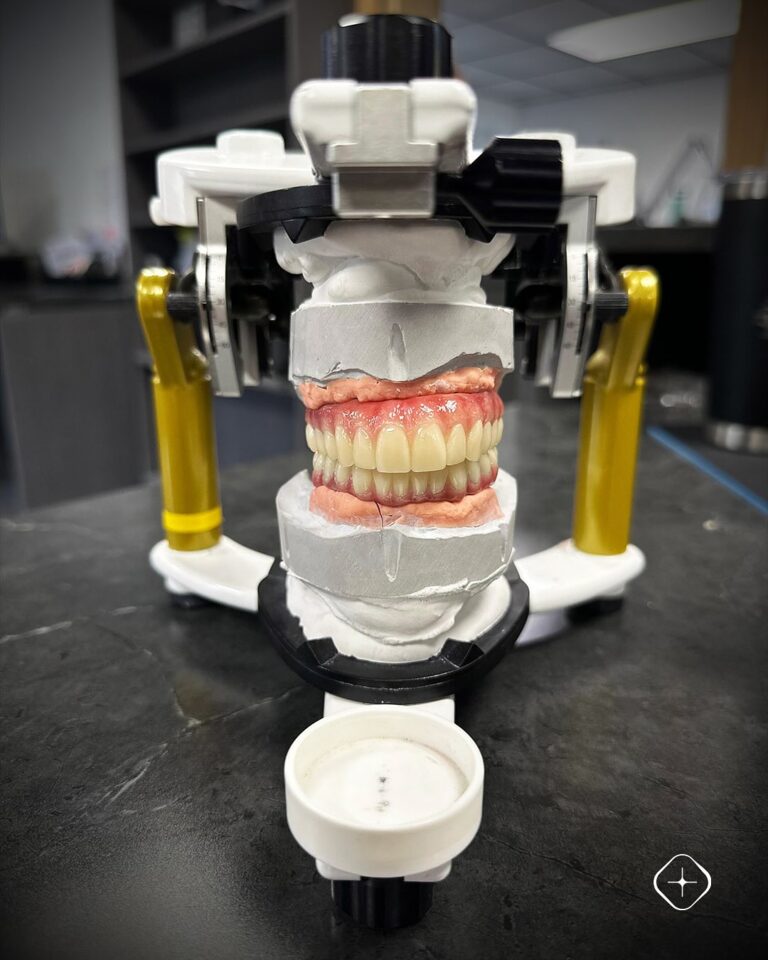 🦷 Prótesis híbrida sobre barra de titanio, fabricadas en Prime Multistratum® y estratificadas c